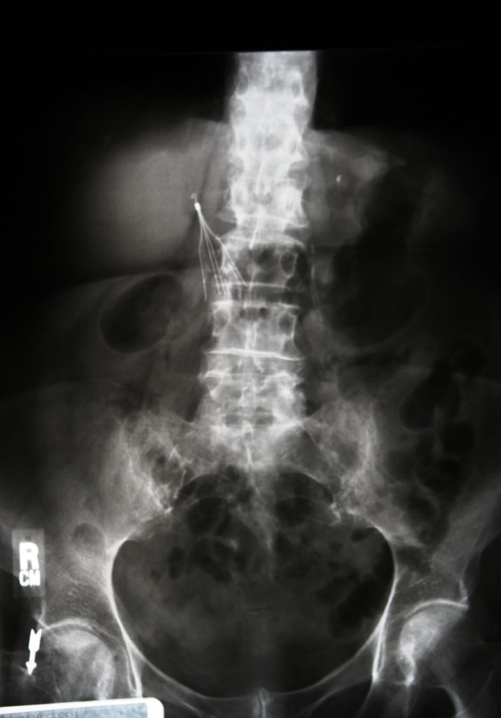 x-ray with IVC filter