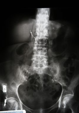 radiografía con filtro IVC