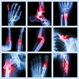 Bone Fracture Xray